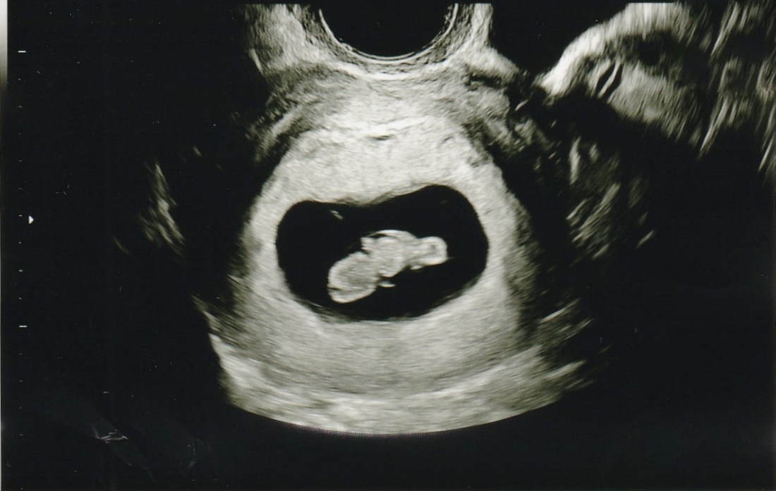 ultrasound-crop-post